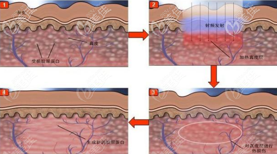 深藍射頻治療原理 深藍射頻治療原理