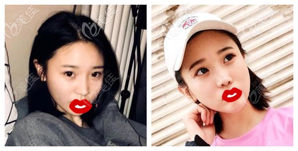 自體肋骨鼻術(shù)后1個(gè)月鼻子腫脹