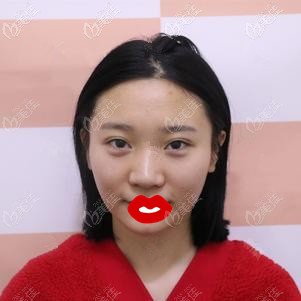 術(shù)前鼻子寬大