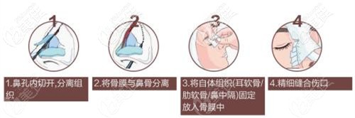 肋骨鼻修復(fù)手術(shù)