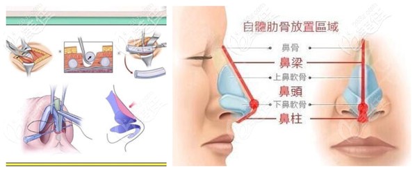 自體肋骨鼻手術(shù)