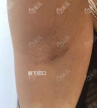 腋下切口恢復(fù)1年效果 腋下切口恢復(fù)1年效果