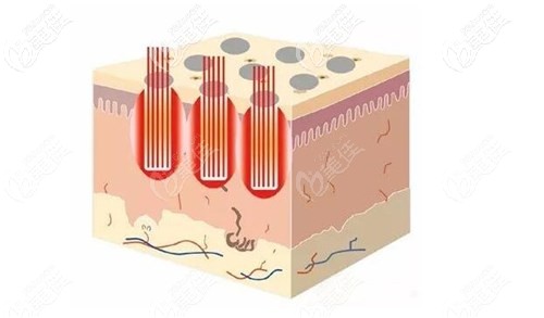 點陣激光治療原理 點陣激光治療原理