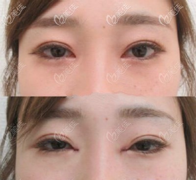 大連愛(ài)得麗格劉志剛內(nèi)眼角修復(fù)成功案例 大連愛(ài)得麗格劉志剛內(nèi)眼角修復(fù)成功案例