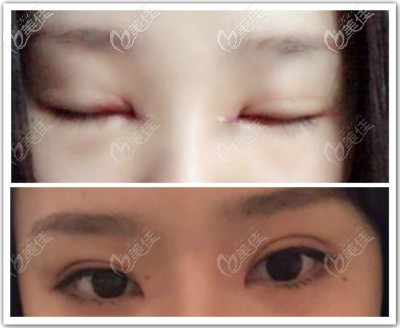 大連愛(ài)得麗格劉志剛眼角修復(fù)好案例圖片 大連愛(ài)得麗格劉志剛眼角修復(fù)好案例圖片