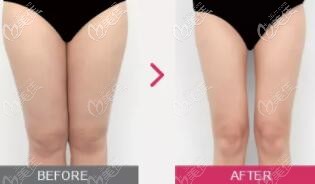 大腿吸脂術(shù)前術(shù)后對(duì)比照