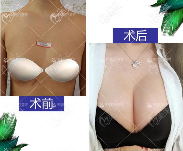 成都恒博天姿雙C復(fù)合豐胸案例效果