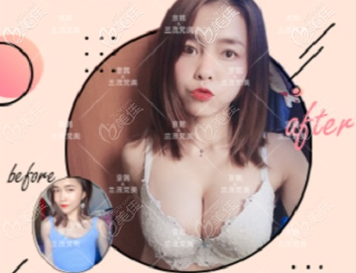 北京王沛森自體脂肪隆胸多少錢？我花12萬多在北京京韓找他做脂肪豐胸效果參考