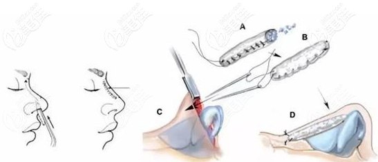肋骨隆鼻手術(shù)過(guò)程