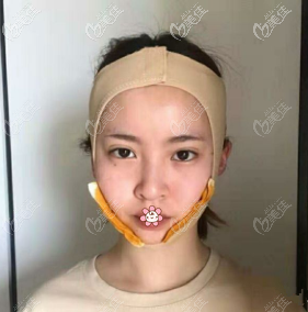 第六天，我還沒拆線