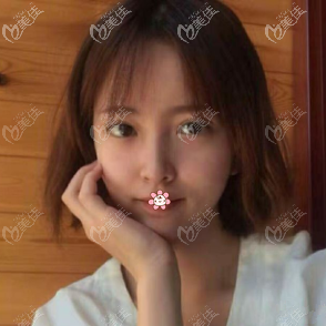 潘寶華院長給我做完下頜角手術(shù)一個月了