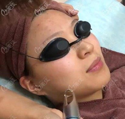 皮秒祛黃祛痘印過(guò)程