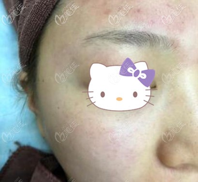 皮秒祛黃提亮膚色術(shù)后即刻效果照