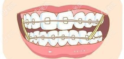 剛開始戴牙套會(huì)有不適應(yīng) 剛開始戴牙套會(huì)有不適應(yīng)