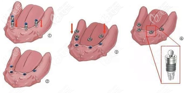 三萬六做的全口半固定種植牙