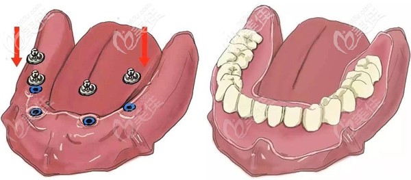 比活動(dòng)假牙好用的半固定種植牙