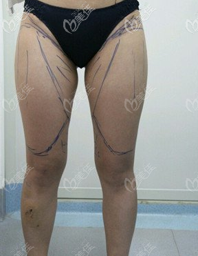 漢中大腿吸脂術(shù)前照片 漢中大腿吸脂術(shù)前照片