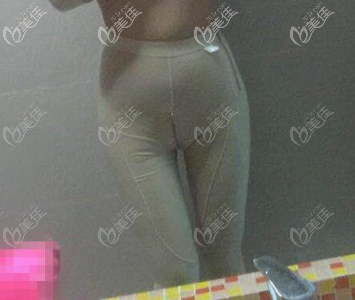 大腿吸脂術(shù)后一個(gè)月的照片 大腿吸脂術(shù)后一個(gè)月的照片