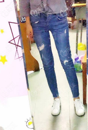 我一個漢中妹子，在名韓做了大腿吸脂后從x腿型變直了