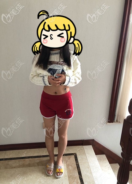 術(shù)前腰腹部肥胖