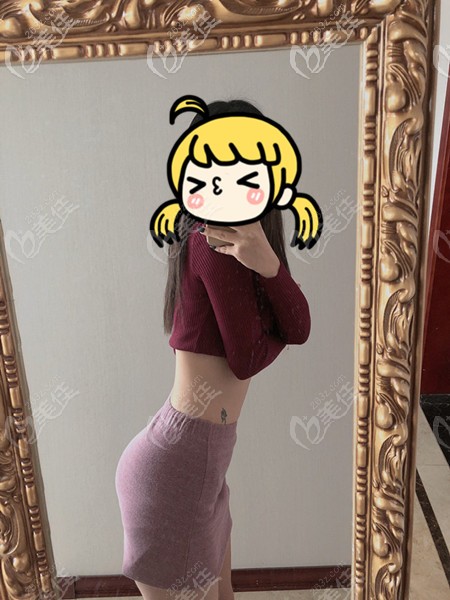 在濟(jì)南海峽做腰腹吸脂術(shù)后2個月恢復(fù)自然