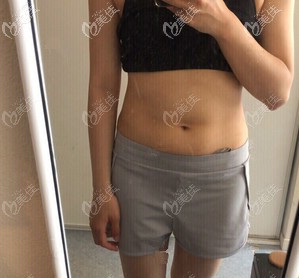 術(shù)前腰腹部贅肉多
