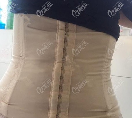 做完腰腹吸脂術(shù)后40天已經(jīng)消腫