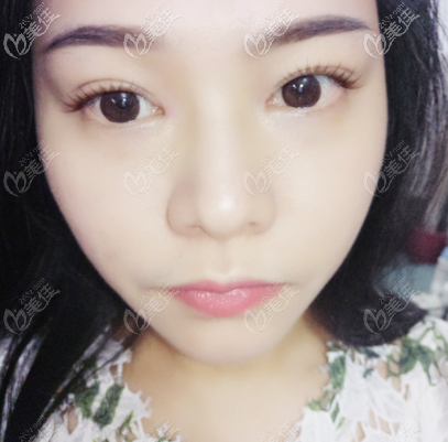 廣州軍美<!--<i data=20240703-sp></i>-->醫(yī)生做的雙眼皮恢復(fù) 廣州軍美<!--<i data=20240703-sp></i>-->醫(yī)生做的雙眼皮恢復(fù)