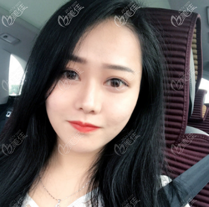 要不是廣州軍美醫(yī)生技術(shù)好我的雙眼皮也不會這么好看哦