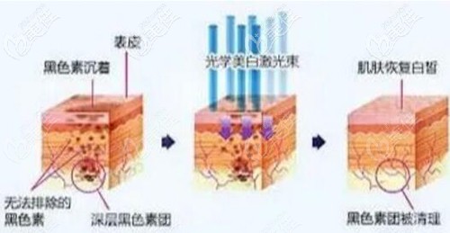 彩光嫩膚的原理