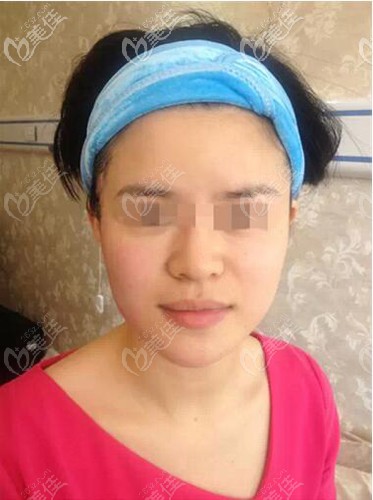 彩光嫩膚右邊臉治療對比效果