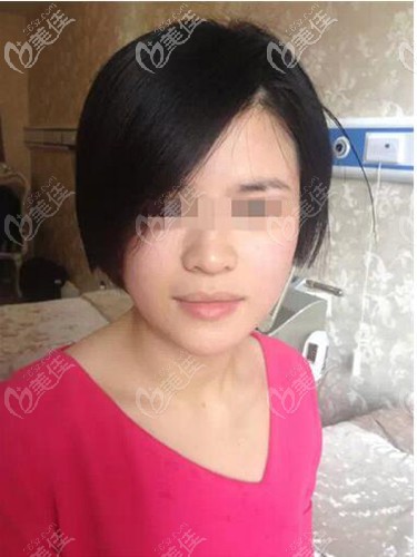 彩光嫩膚兩邊臉治療后效果