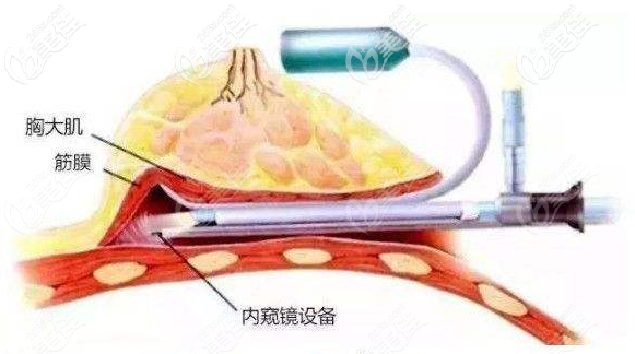 內(nèi)窺鏡隆胸