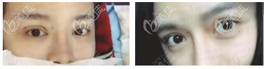 生物焊接雙眼皮案例效果 生物焊接雙眼皮案例效果