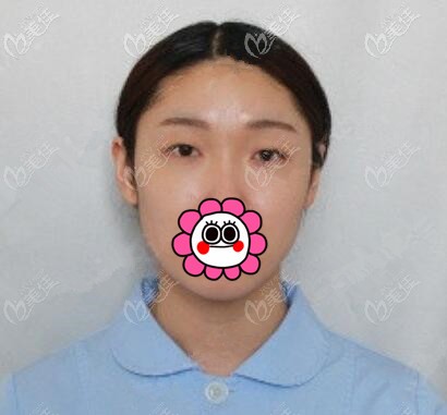 做雙眼皮術(shù)前照 做雙眼皮術(shù)前照