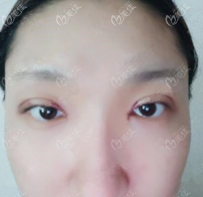 埋線雙眼皮術(shù)后第3天 埋線雙眼皮術(shù)后第3天