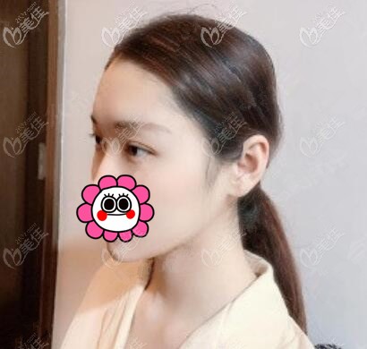 微創(chuàng)埋線雙眼皮術(shù)后第7天 微創(chuàng)埋線雙眼皮術(shù)后第7天