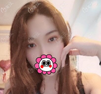 埋線雙眼皮術(shù)后第15天效果 埋線雙眼皮術(shù)后第15天效果