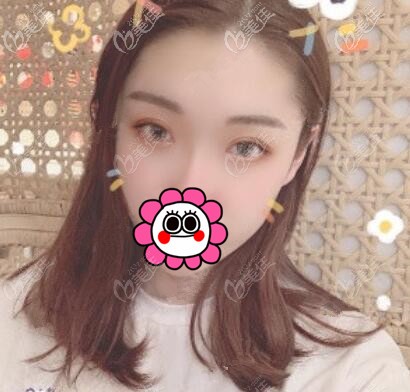 想知道微創(chuàng)埋線雙眼皮效果好不好？來看我術(shù)后30天的恢復(fù)效果圖就知道了！