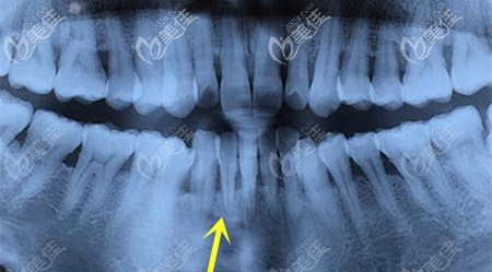 牙齦萎縮的照片