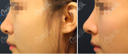 玻尿酸隆鼻前后一個月的對比照片