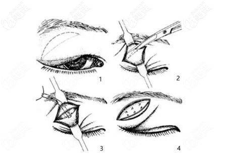 淚腺脫垂手術(shù)矯正方法