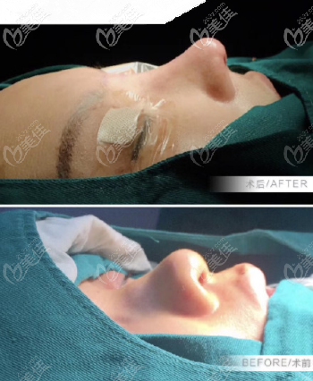 <!--<i data=20240703-sp></i>-->膨體+半肋鼻綜合案例