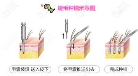 睫毛種植過程示意圖