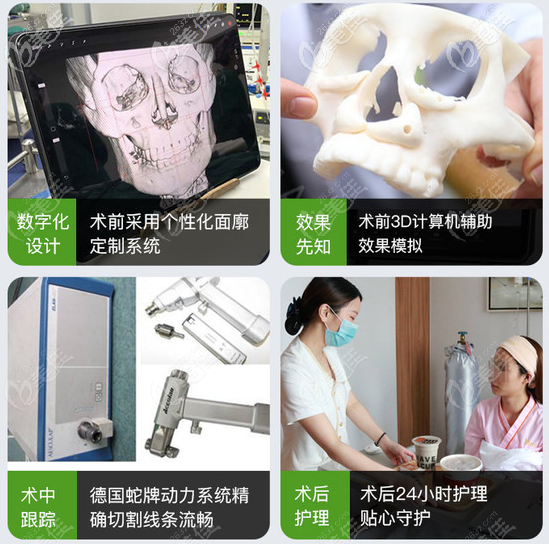 下頜角磨骨手術(shù)過程