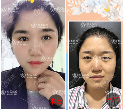 我找桂行軍做眼綜合案例效果給你參考北京彤美誰做眼睛好