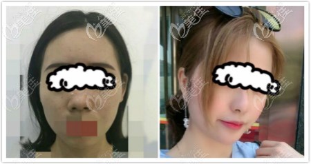 我做合資艷冠假體隆鼻一年后效果圖片分享給大家