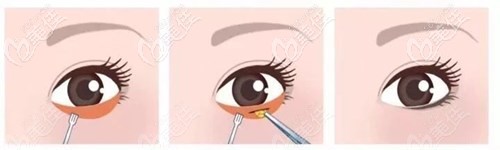 去眼袋手術(shù)過程 去眼袋手術(shù)過程