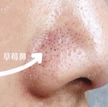 草莓鼻的形成主要原因 草莓鼻的形成主要原因