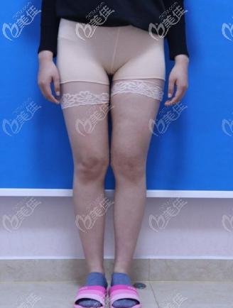 術(shù)前的我大腿 術(shù)前的我大腿